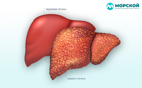 Сравнение здоровой и больной циррозом печени